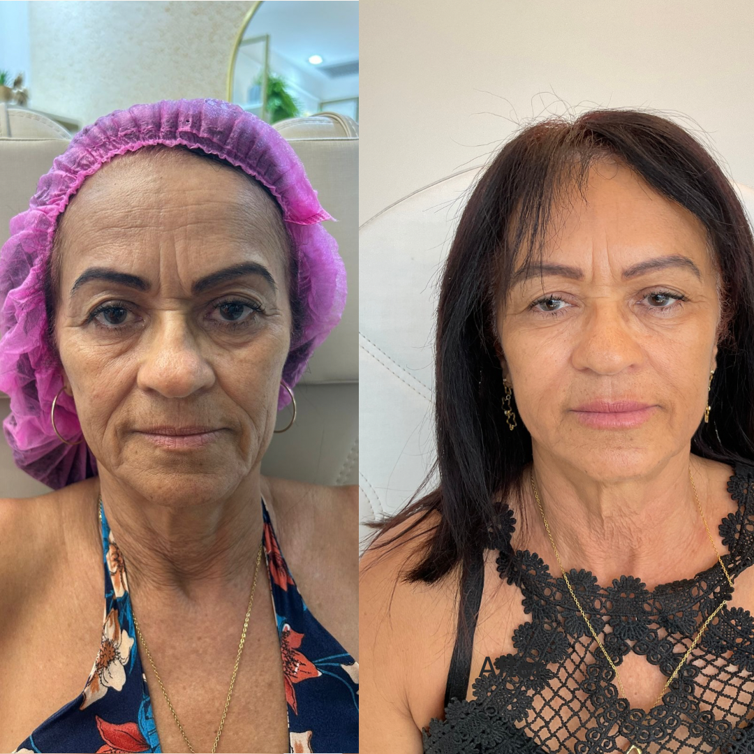 Beige Minimalist Skincare Before and After Instagram Post-1