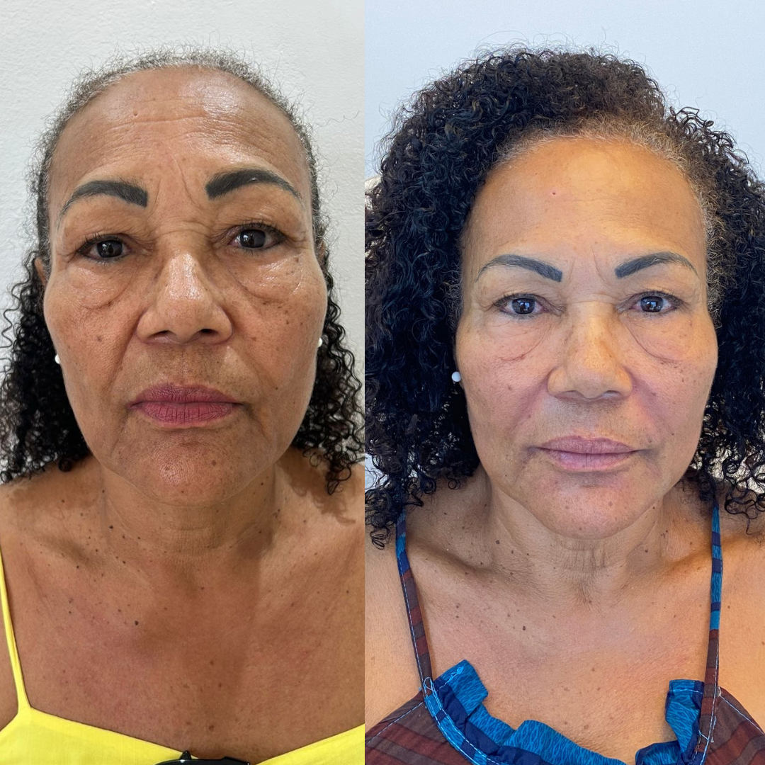 Beige Minimalist Skincare Before and After Instagram Post-2