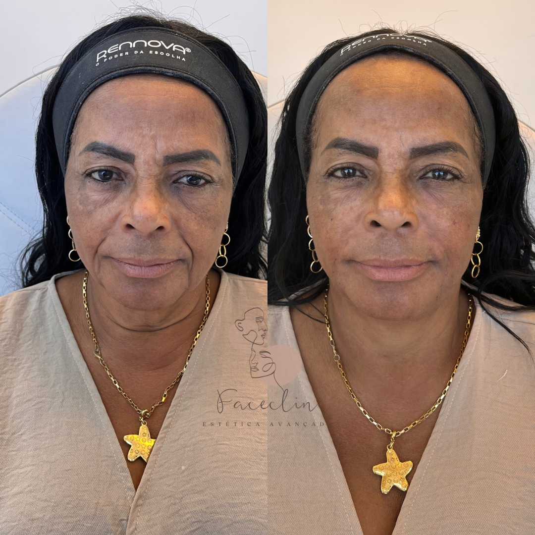Beige Minimalist Skincare Before and After Instagram Post